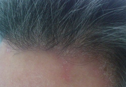 Nguyên nhân và cách điều trị nấm da đầu